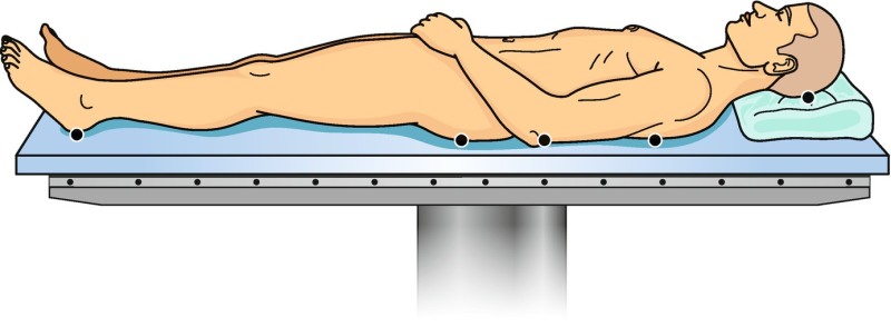 Fig. 12.1, [Supine position with typical pressure points]. - Compartment  Syndrome - NCBI Bookshelf, supine position 