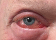 Chemosis: conjunctival edema and inflammation