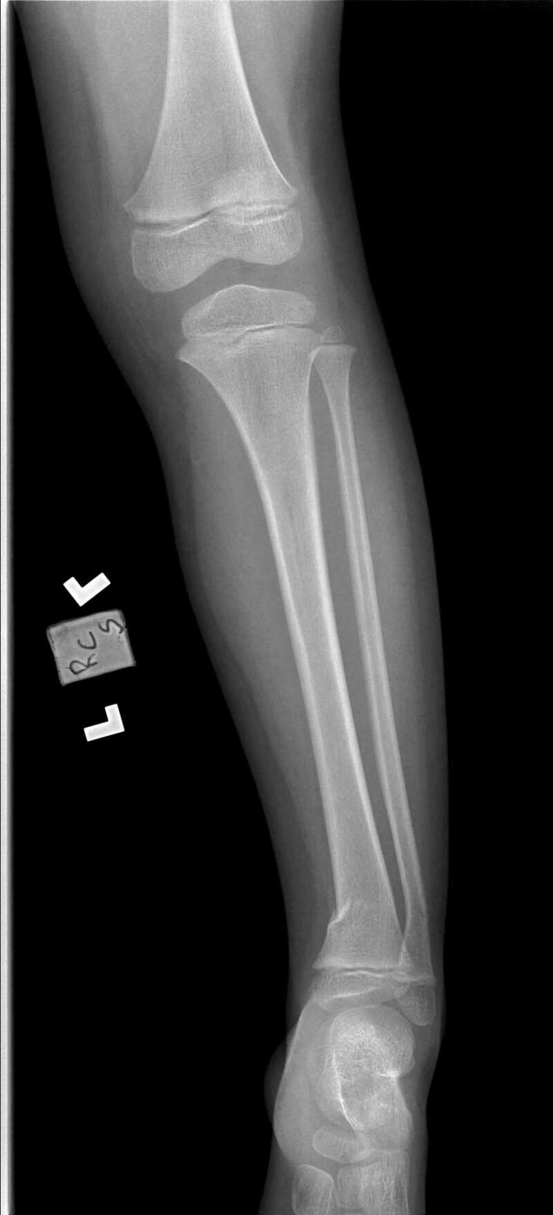 tibia and fibula x ray