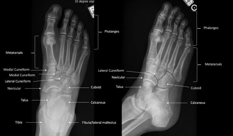 Oblique Foot X Ray Anatomy Hot Sex Picture