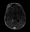 Axial T1 Postcontrast Brain MRI