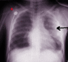 Pulmonary Contusion Radiograph