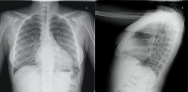 Normal Lateral Chest Xray