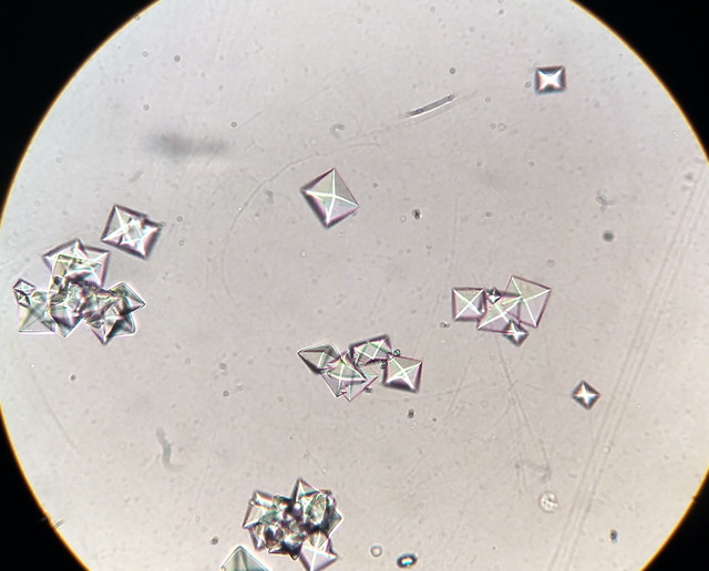 Microscopic view of calcium oxalate crystals in urine