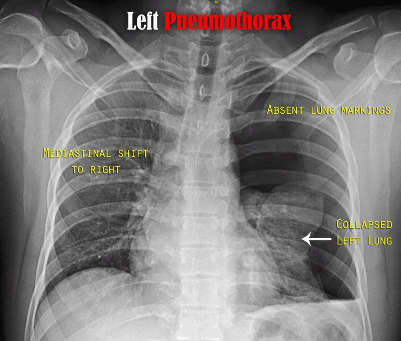 Figure, Left-Sided Tension Pneumothorax Radiograph. This ...