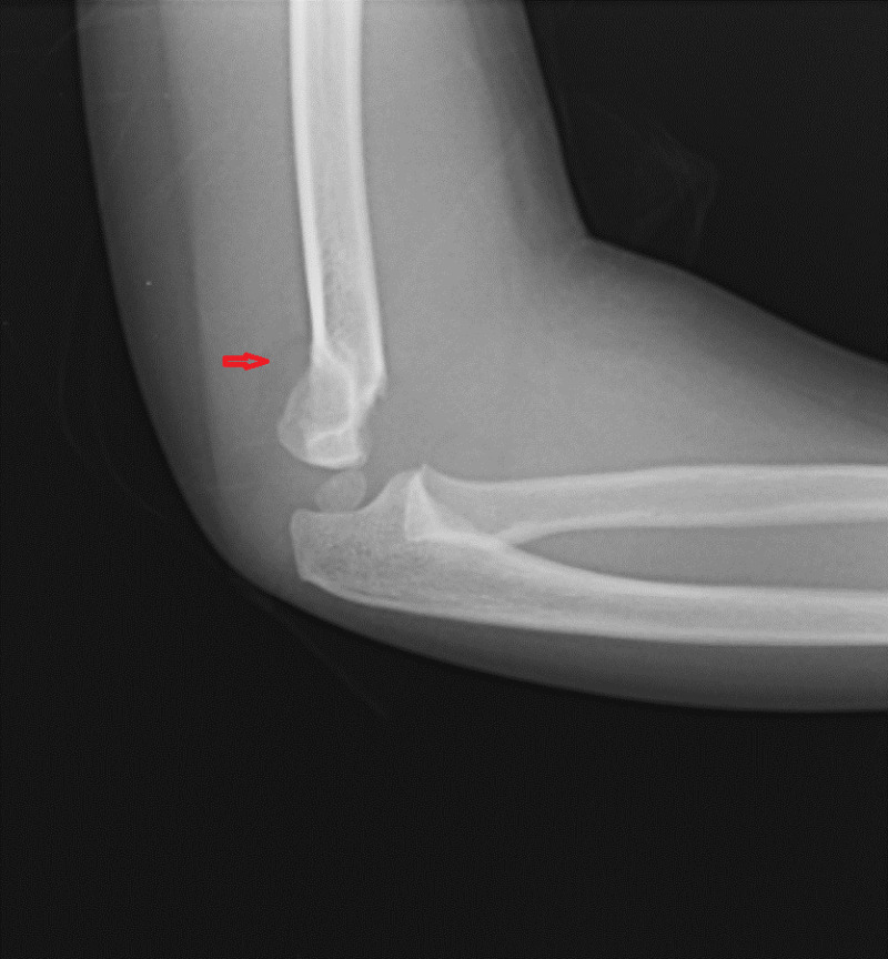 Figure Posterior Fat Pad Sign Supracondylar Fracture Contributed