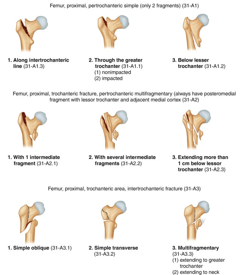 Ao Hip Fracture Classification