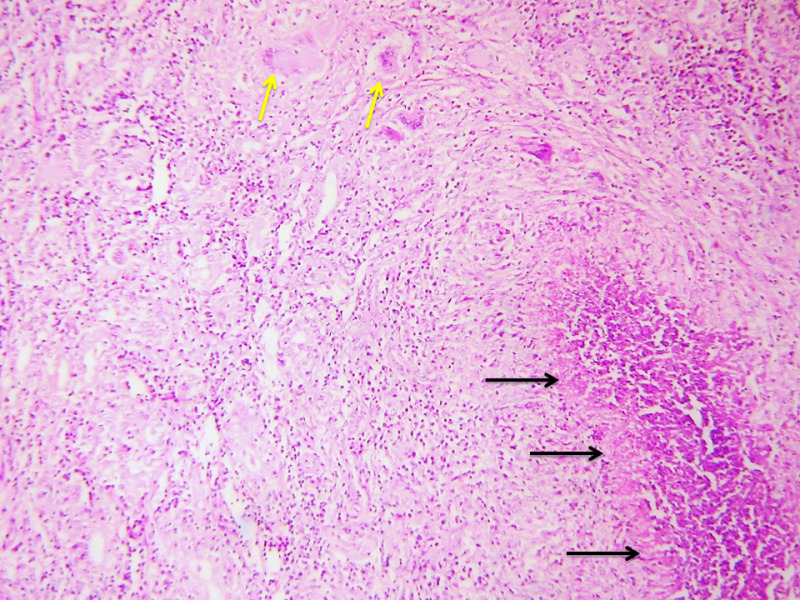 Fig 4. . Case of TTB showing granulomas within the thyroid parenchyma comprised of epithelioid cells with Langhan’s giant cells (yellow arrows) and foci of necrosis (black arrows).