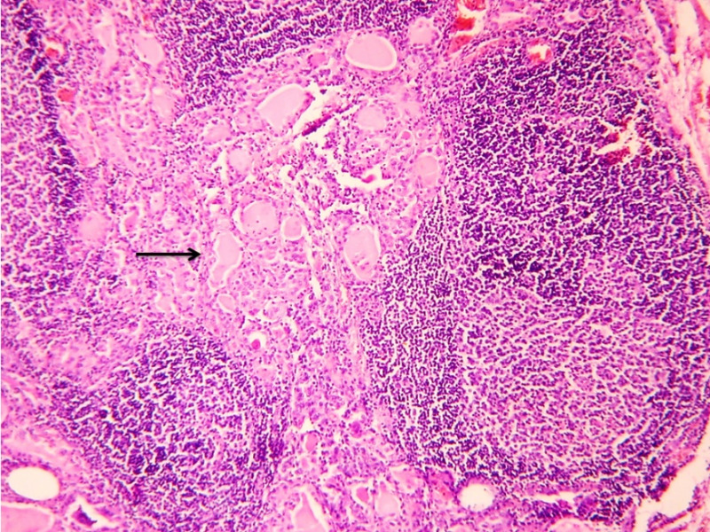 Figure 5. . Case of TTB showing dense lymphocytic infiltrate with prominent germinal centers in the thyroid parenchyma (arrow).