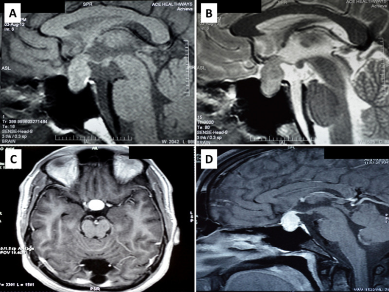 Figure 8. . Magnetic resonance imaging of a patient with pituitary tuberculosis shows a sellar mass lesion measuring 2.