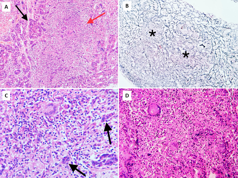 Figure 9. . Pituitary tuberculosis.