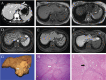 Figure 1. Representative images of focal nodular hyperplasia.