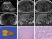Figure 3. Representative images of hepatocellular carcinoma.