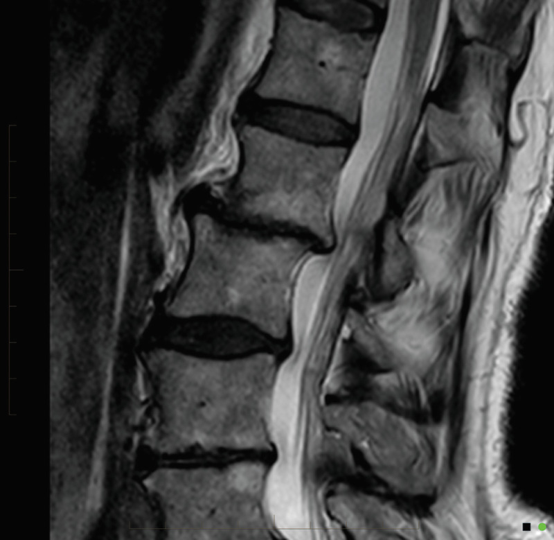 Fig. 14.5, [Severe facet joint arthrosis with ...