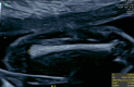 An ultrasound image showing a fetal femur measurement with estimated gestational age of 20 weeks and 2 days