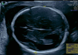 This ultrasound image demonstrates a fetal biparietal diameter and a head circumference in the second trimester with an estimated gestational age of 21 weeks 1 day and 20 weeks 2 days, respectively