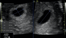 Measurement of this gestational sac in more than one plane helps to determine the gestational age in this ultrasound image