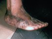 Progressing Eumycetoma With Deep-Tissue Penetration of Right Foot