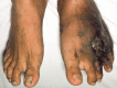Advanced Eumycetoma With Gangrenous Features in the Left Foot