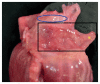 Image 7.3A. Dissection of the right atrium to sample the SA node.