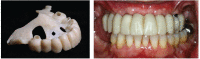 Figure 10. 3D Printed denture teeth processed and seated on supporting dental implants
Figure 10 includes two photographs of dentures. On the left is a picture of dentures outside of the body and on a black background. The photograph on the right is an image of dentures seated on supporting dental implants inside of subject’s mouth.
Notes: Digital denture designed with CAD/CAM software and denture teeth 3D printed. Dentures can be designed in less than 20 minutes and printed in as little as 30 minutes.
Source: Dr. Gustavo Mendonca