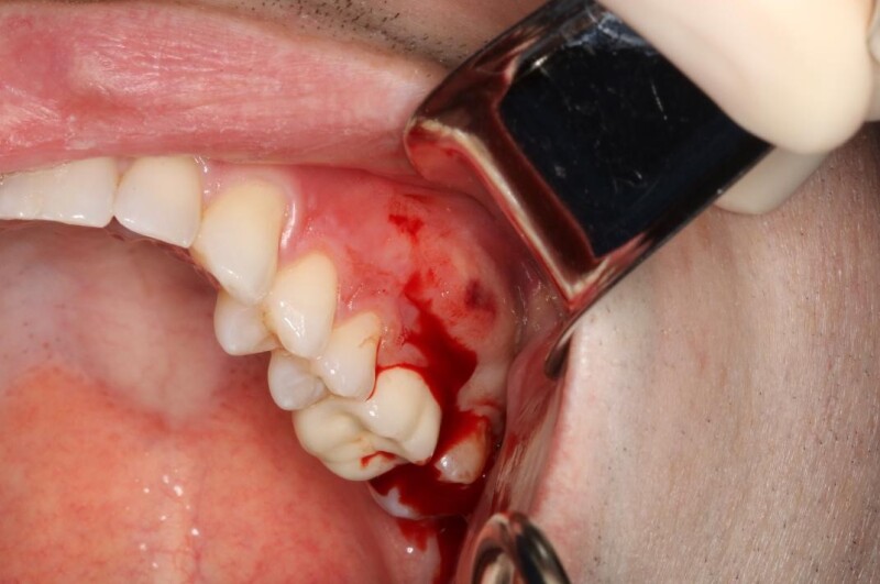 Figure Acute Apical Abscess Contributed By Reed Mckinney Dds