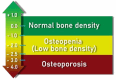 Figure 2. Classification of bone disease based on BMD measurements.