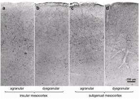 Figure 14. Advanced telencephalic pathology in the insular and subgenual mesocortex of an IPD case.