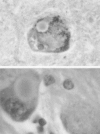 Figure 2. Lewy bodies are circular eosinophilic hyaline structures found in neurons of the substantia nigra and other brain areas in Parkinson's disease.