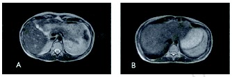 Figure 5. Disappearance of multiple melanoma metastases in liver.