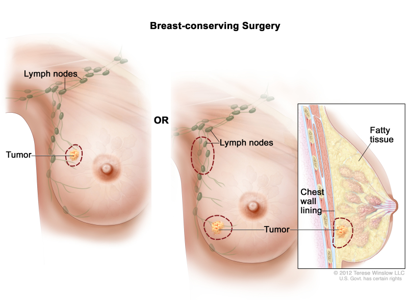 Breast Cancer Treatment During Pregnancy (PDQ®) - PDQ Cancer