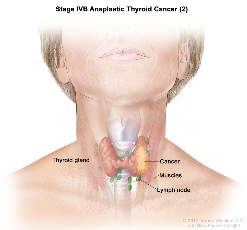 Table Table 6 Definitions Of Anaplastic Tnm Stages Iva Ivb And Ivc For Papillary And Follicular Thyroid Carcinomaa Pdq Cancer Information Summaries Ncbi Bookshelf