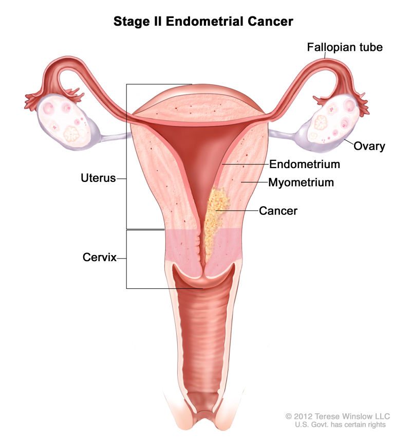 Endometrial Cancer Treatment Pdq Pdq Cancer Information Summaries Ncbi Bookshelf