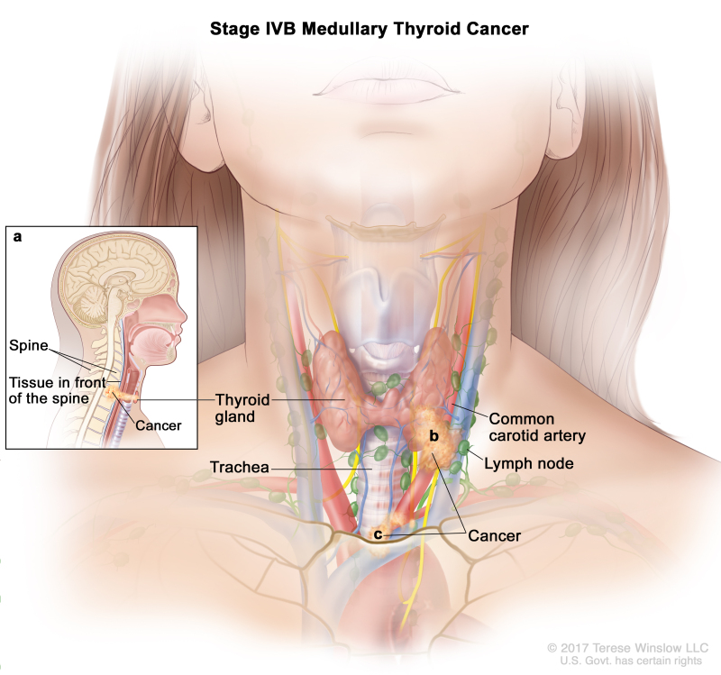 Thyroid Cancer Treatment (Adult) (PDQ®) - PDQ Cancer Information Summaries - NCBI Bookshelf