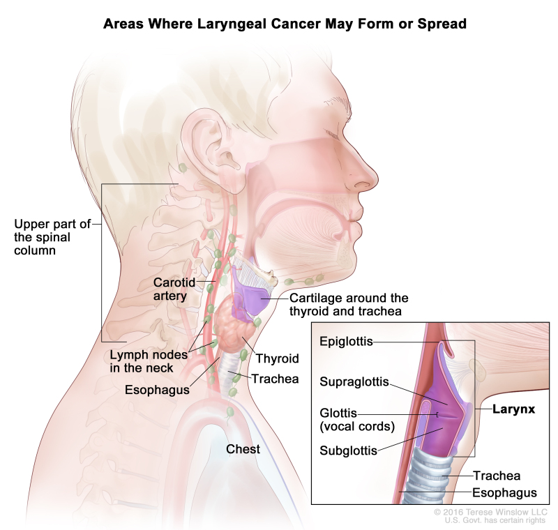 Laryngeal Cancer Treatment (PDQ®) - PDQ Cancer Information ...