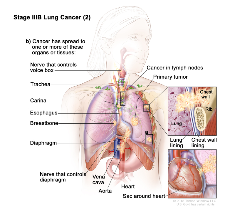 Treatment Of Lung Cancer