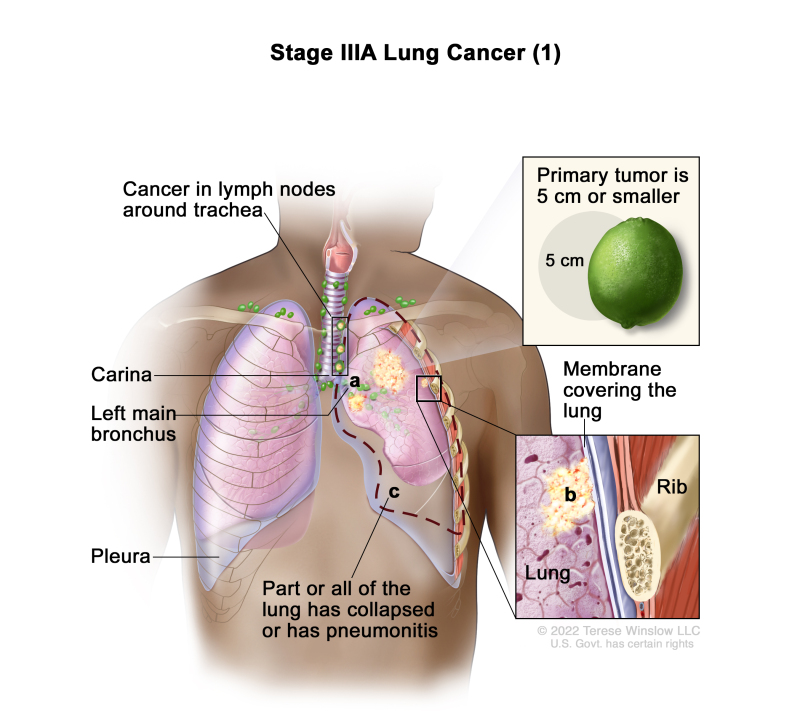 what is the life expectancy of stage 4 lung cancer without treatment