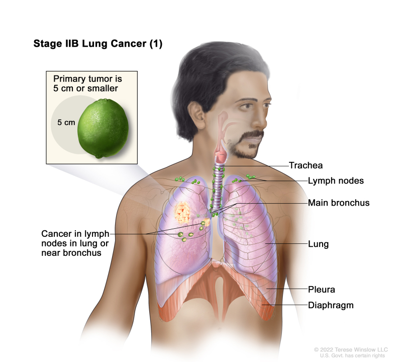 Tumor Size Chart Lung Cancer