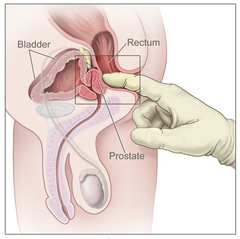 prostate ncbi)