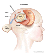 Craniotomy: An opening is made in the skull and a piece of the skull is removed to show part of the brain