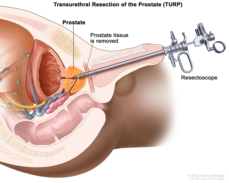 prostate cancer treatment ncbi a csukló ízületének gyulladása