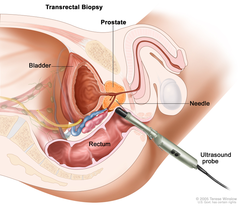 Prostate cancer symptoms ncbi,