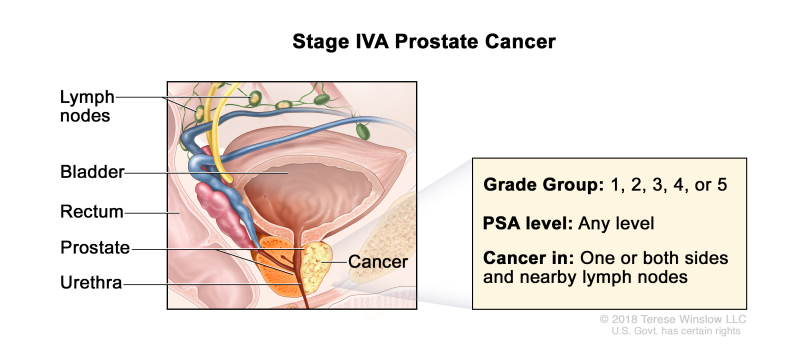 prostate cancer ncbi prostatita co trimoxazol