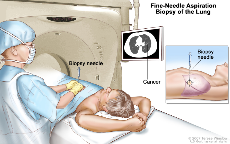 Fine-needle aspiration biopsy of the lung; drawing shows a patient lying on a table that slides through the computed tomography (CT) machine with an x-ray picture of a cross-section of the lung on a monitor above the patient. Drawing also shows a doctor using the x-ray picture to help place the biopsy needle through the chest wall and into the area of abnormal lung tissue. Inset shows a side view of the chest cavity and lungs with the biopsy needle inserted into the area of abnormal tissue.