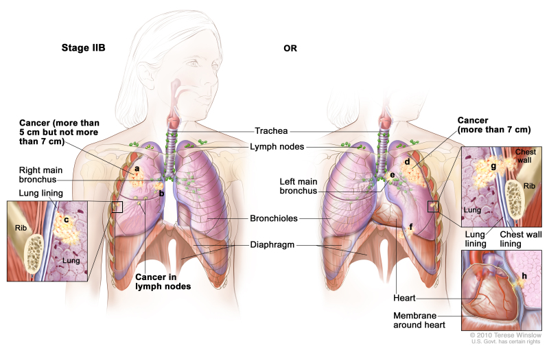Two-panel drawing of stage IIB non-small cell lung cancer. First panel shows cancer (more than 5 cm but not more than 7 cm), and cancer in the right main bronchus and lymph nodes; also shown are the trachea, bronchioles, and diaphragm. Inset shows cancer that has spread from the lung to the innermost layer of the lung lining; a rib is also shown. Second panel shows cancer (more than 7 cm), and cancer in the left main bronchus; also shown are the trachea, lymph nodes, bronchioles, and diaphragm. Top inset shows cancer that has spread from the lung through the lung lining and chest wall lining into the chest wall; a rib is also shown. Bottom inset shows the heart and cancer that has spread from the lung into the membrane around the heart.