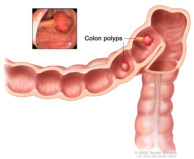 rectal cancer ncbi)