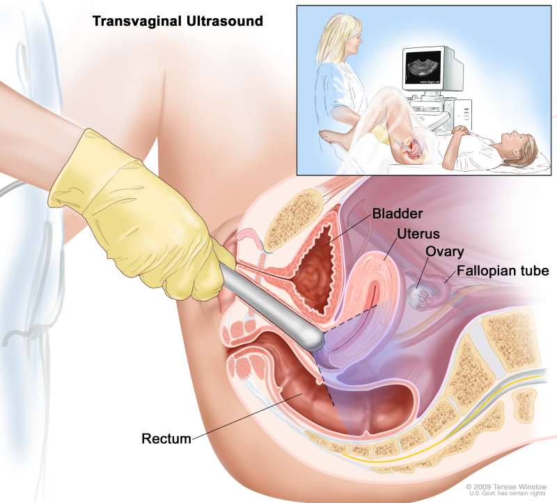 Figure, Transvaginal ultrasound. An ultrasound probe...] - PDQ Cancer  Information Summaries - NCBI Bookshelf