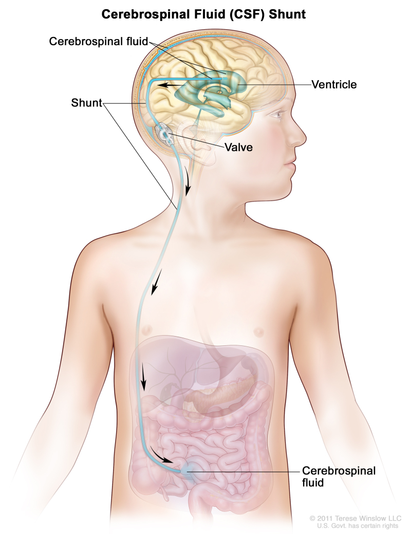 Figure, A cerebrospinal fluid (CSF) shunt] - PDQ Cancer Information  Summaries - NCBI Bookshelf