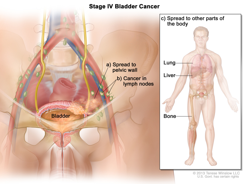 cancer in abdominal lymph nodes cum să eliminați papiloamele pe un deget