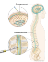 Intrathecal chemotherapy